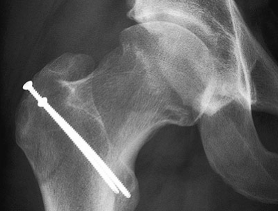 Abb. 4: Röntgenbild der rechten Hüfte nach Abtragen der Knochenanlagerungen am Schenkelhals, gleicher Patient wie Abb. 2.